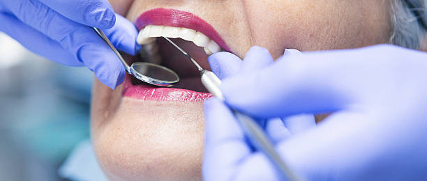 Best Knocked-Out Tooth (Avulsed Tooth) Treatment in Riverdale Park, CA